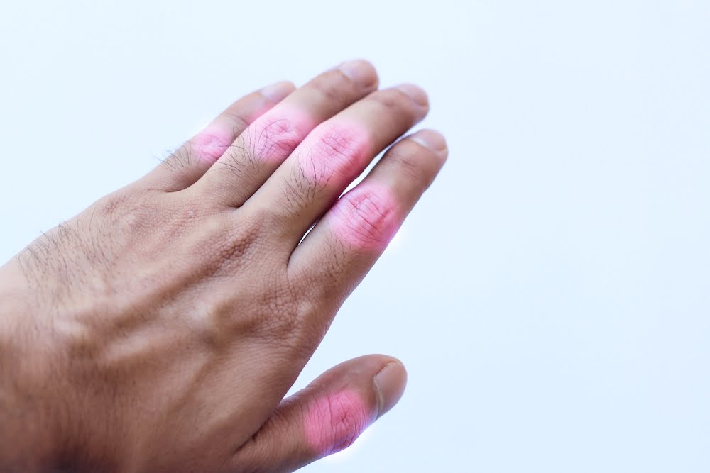 8 Homeopathy Remedies for Arthritis Patients